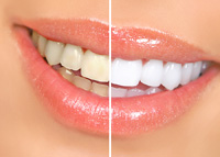 Teeth Whitening Houston TX | Dentist